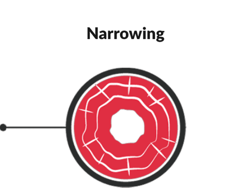 EoE Inflammation and Fibrosis Illustration