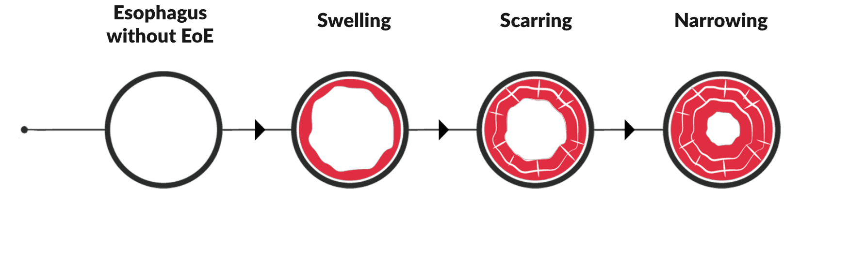 EoE Inflammation and Fibrosis Illustration